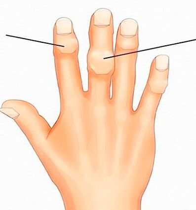 Heberdenovy a Bouchardovy uzliny na interfalangeálních kloubech s artrózou