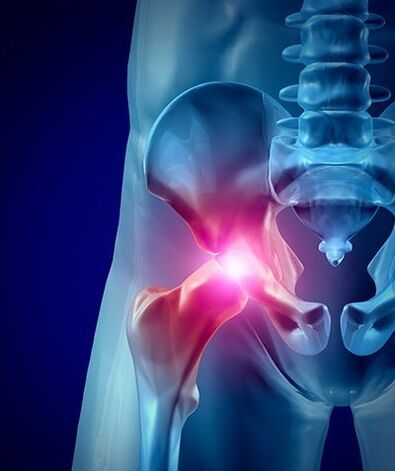 bolest kyčle foto 1