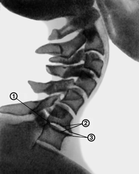 Rentgenový snímek krční páteře s osteochondrózou