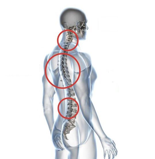 Jak se osteochondróza projevuje