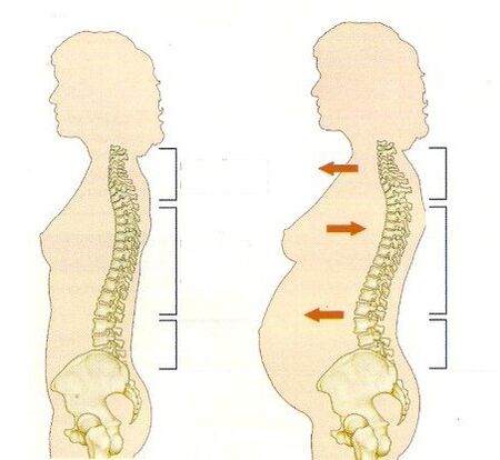 osteochondróza během těhotenství