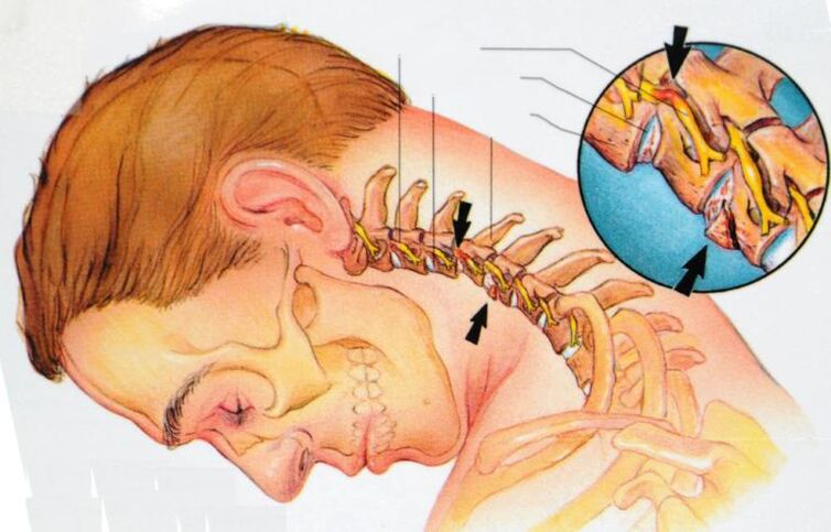 příznaky cervikální osteochondrózy
