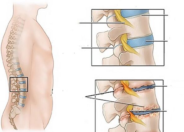 změny disků v důsledku osteochondrózy